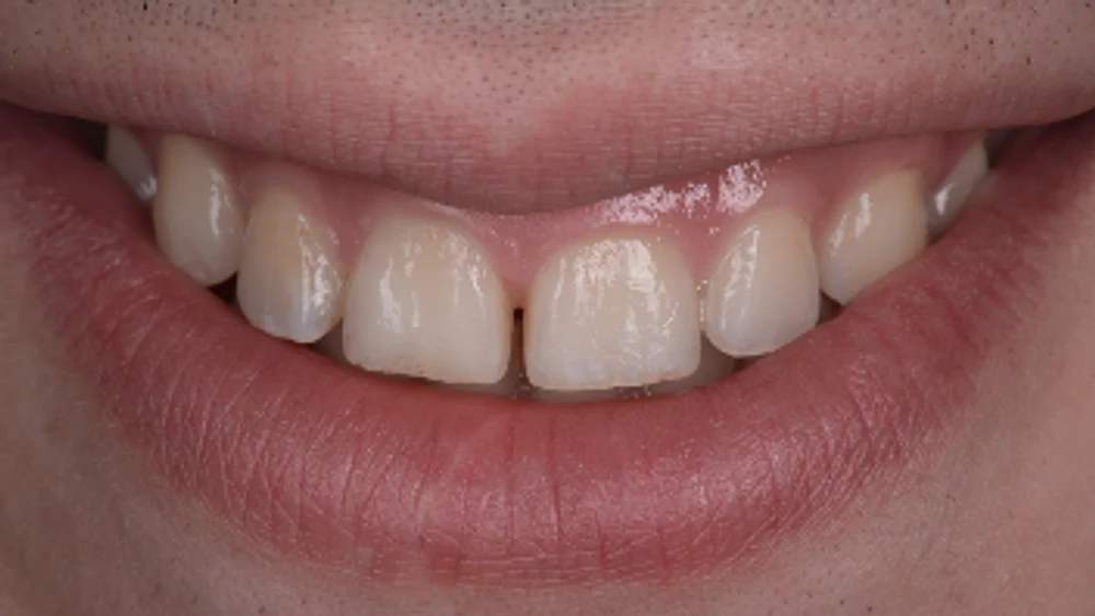 Carilles de composite · Abans