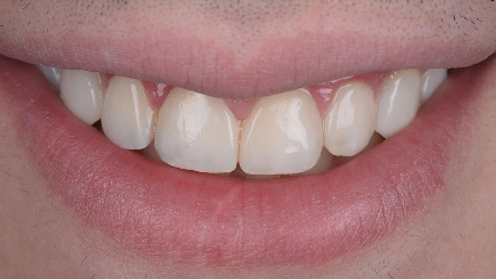 Estètica dental · Després